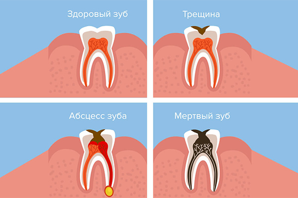 абсцесс зуба