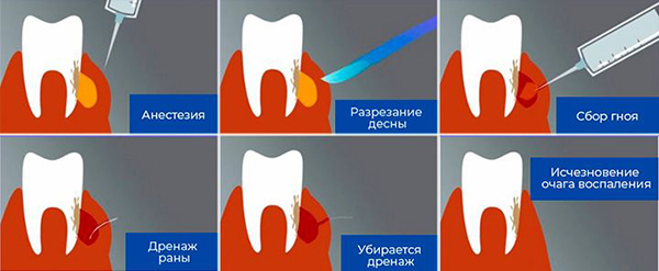лечение абсцесса зуба